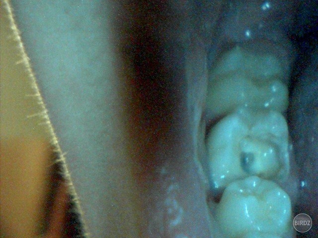 Odlomený zub