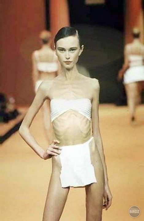 Ana Carolina Reston
* 4.6.1985
+ 15.11.2006
Príčina smrti: komplikácie spôsobené anorexiou