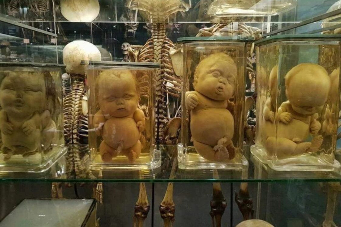 Degenerovaní novorodenci naložený vo formaldehyde, múzeum ľudského tela Amsterdam