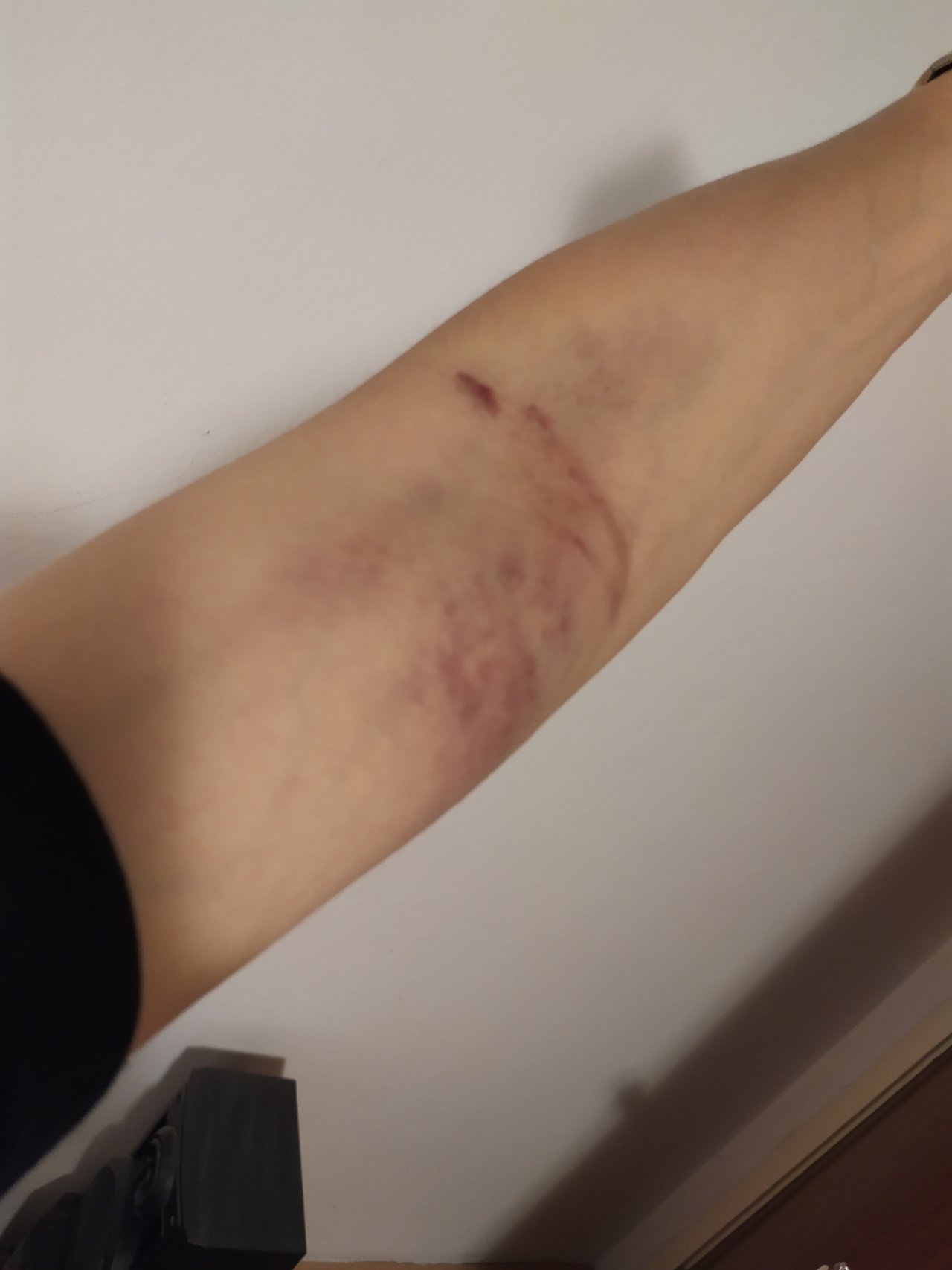 Taka skromna modrina po vcerajsem odbere krvi