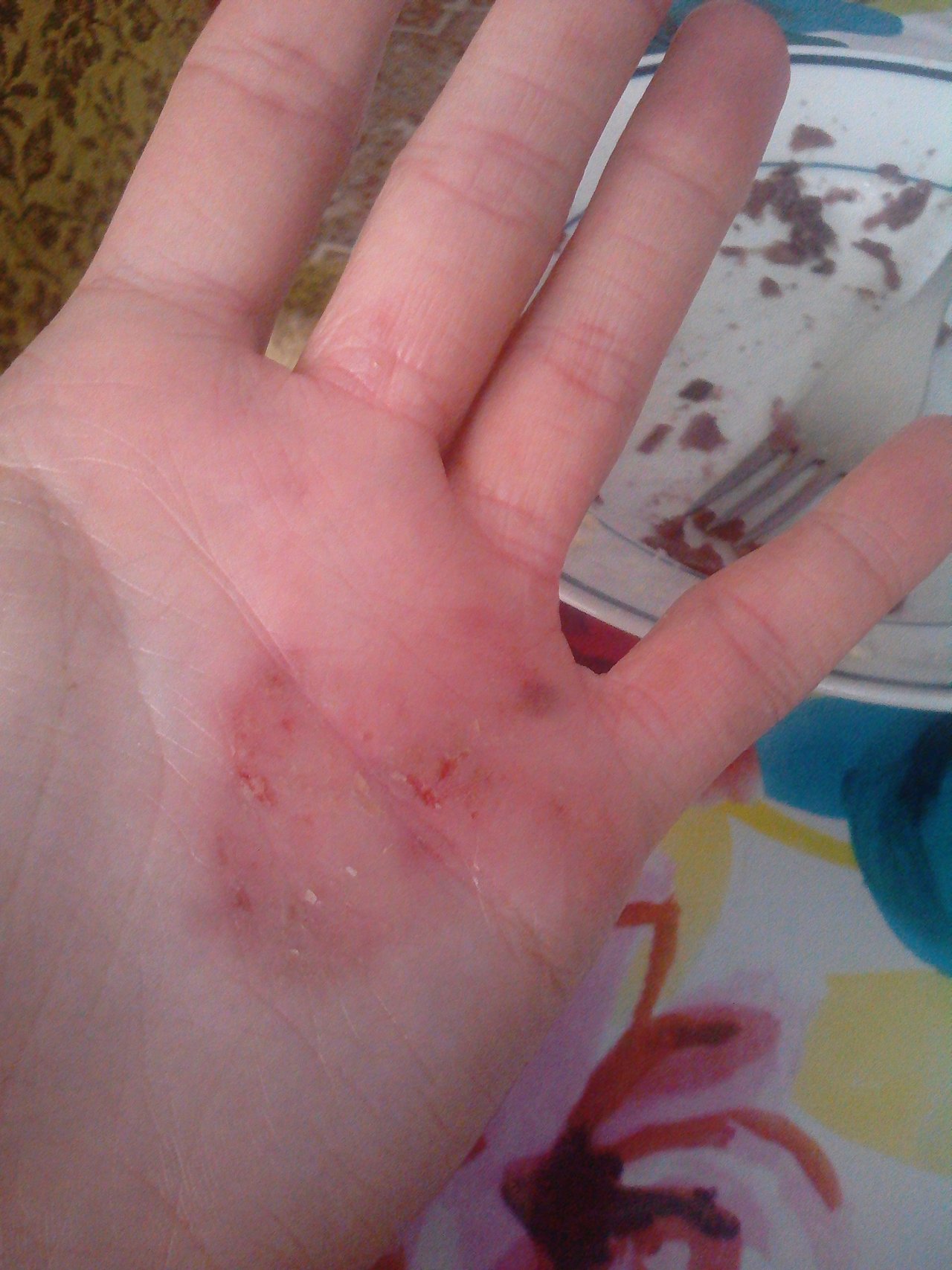 Hhhrôza menom Ekzém(asi alergia na gumove rukavice)..:(